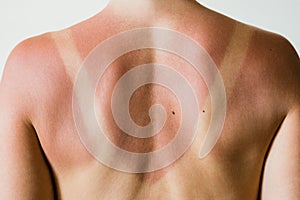 Sunburn marks on a woman`s back