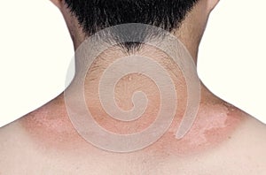Sunburn peeling discoloration or sun burn dermatitis in the upper back