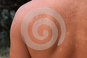 Sunburn on the skin of the back. Exfoliation, skin peels off. Dangerous sun tan