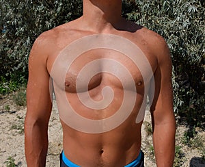 Sunburn on the skin of the chest and abdomen of a man. Exfoliation, skin peels off. Dangerous sun tan