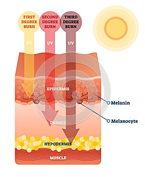 Sunburn skin damage anatomical cross section diagram