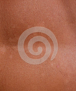 Sunburn on the skin of the . Exfoliation, skin peels off. Dangerous sun tan