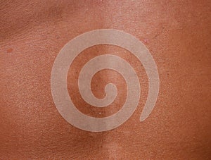 Sunburn on the skin of the stomach. Exfoliation, skin peels off. Dangerous sun tan