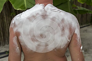 Sunburned man with cooling foam on her back. Man got sunburn and tan on her shoulder. Skin care concept