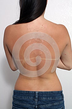 Sunburned, Peeling Female (1)