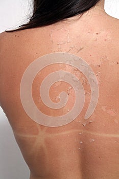 Sunburned, Peeling Female (2) photo