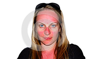 Sunburns on a girl's face