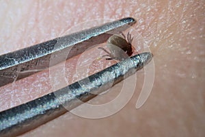 Super close up of sucking tick Ixodes ricinus removal with steel tweezers on human skin