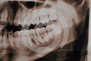 Supercomplete teeth. x-ray