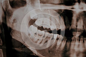 Supercomplete teeth. x-ray