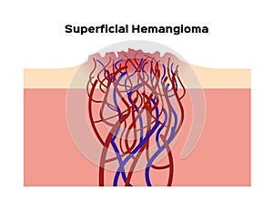 Superficial hemangioma / organ and anatomy photo