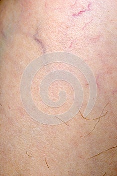 Superficial vein dilatation