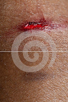 Superficial wound before and after a connective tissue treatment