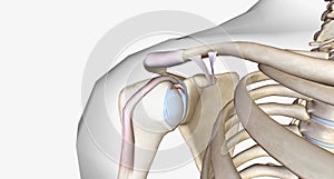 A superior labral tear is when a lesion is found in the upper portion for the labrum