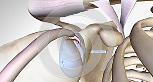 A superior labral tear is when a lesion is found in the upper portion for the labrum photo