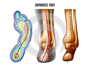 Supinated foot, arch deformation, bottom and back view . Foot weight distribution.