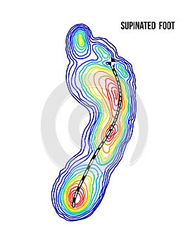 Supinated foot, arch deformation, bottom view. Foot weight distribution. photo