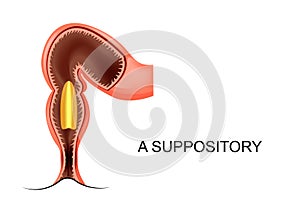 A suppository in the anus