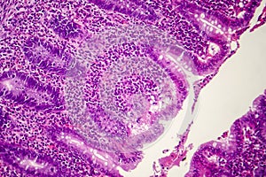 Suppurative appendicitis, light micrograph