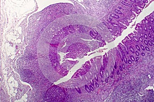 Suppurative appendicitis, light micrograph