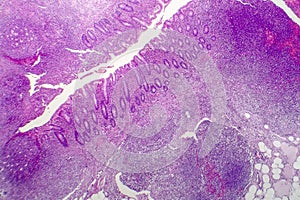 Suppurative appendicitis, light micrograph