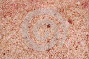The surface of the skin back the elderly old woman. A lot of moles