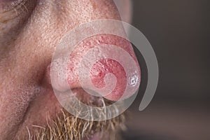 The surface of the skin with rosacea and eczema