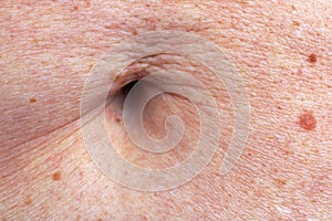 The surface of the stomach skin and navel of the elderly old woman. A lot of moles