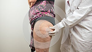 surgeon doing a medical check up by palpating the buttock, on adipose tissues, cellulite, on a female patient with, seen