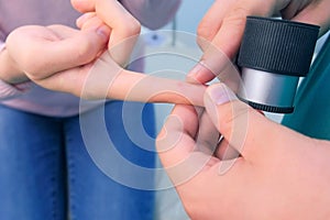 Surgeon examines wart on finger using dermatoscope magnifier before removing.