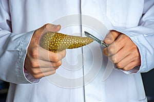 Surgeon held scalpel over anatomical model of human pancreas gland, holding it in his hand against background of body in uniform.