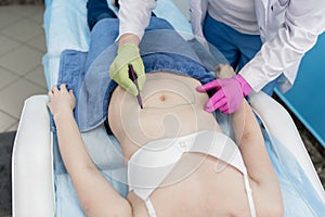 Surgeon Preparing Woman For Liposuction Surgery