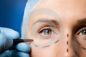Surgeon preparing woman`s face for plastic surgery. facelift procedure