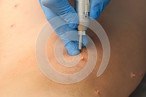 Surgeon removing papilloma using laser on man body, burning skin, closeup view.