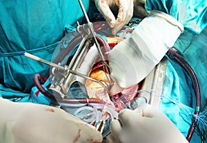 Surgeon is tying a knot