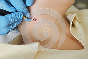 surgeon uses a radio wave knife to remove a neoplasm - a mole or nevus on the neck of a female patient. photo