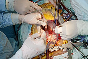 Surgeons hands at cardiac surgery operation