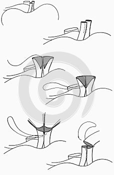 Surgery - Anomalous Coronary Artery Repair Technique