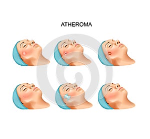 Surgery of benign tumors of atheroma