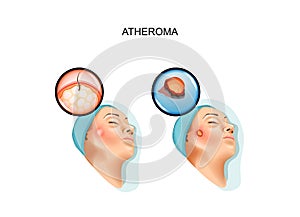 Surgery of benign tumors of atheroma