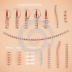 Surgical Stitches Infographic Set