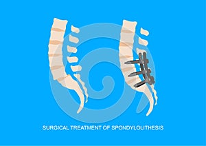 Surgical treatment of slipped lumbrosacral vertebra