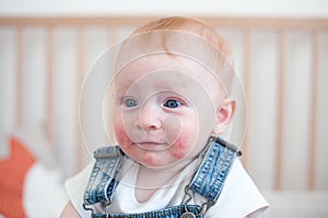 Child with atopic dermatitis photo