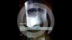 Swallowing study for dysphagia - HD video, black and white