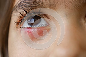 Swelled eye lid of a little girl, Swelling eye of a child, Infection on eye