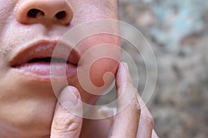 Swelling at the cheek of Asian man. Inflammation of parotid gland called parotitis. Mumps photo
