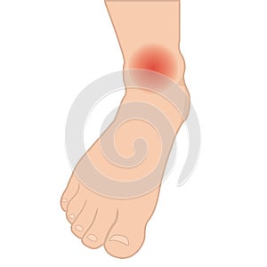 Swelling of the feet and ankles from infected or injury