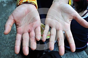 Swelling hand