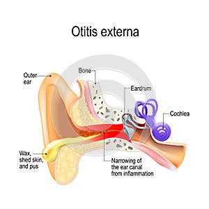 Swimmer`s ear. Otitis externa
