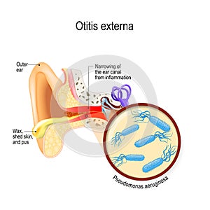 Swimmer`s ear. Otitis externa